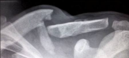 Lorenzo's collarbone at Assen